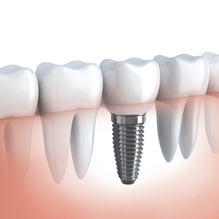 implantes-dentarios-clinica-medica-dentaria-alexandra-fonseca-viseu